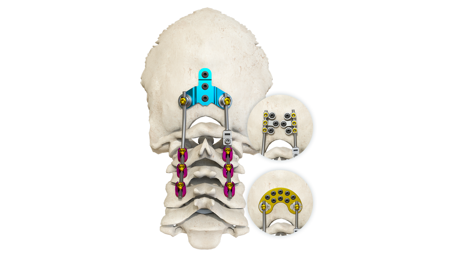 Cervical Fixation nhyehyɛe
