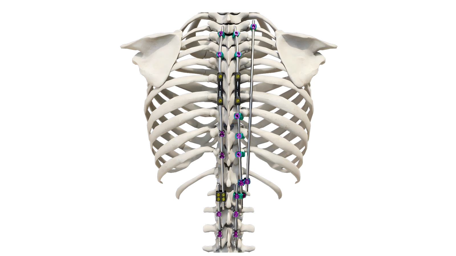 NOAH™ 4.5 Pediatric Thoracolumbar Fixation System