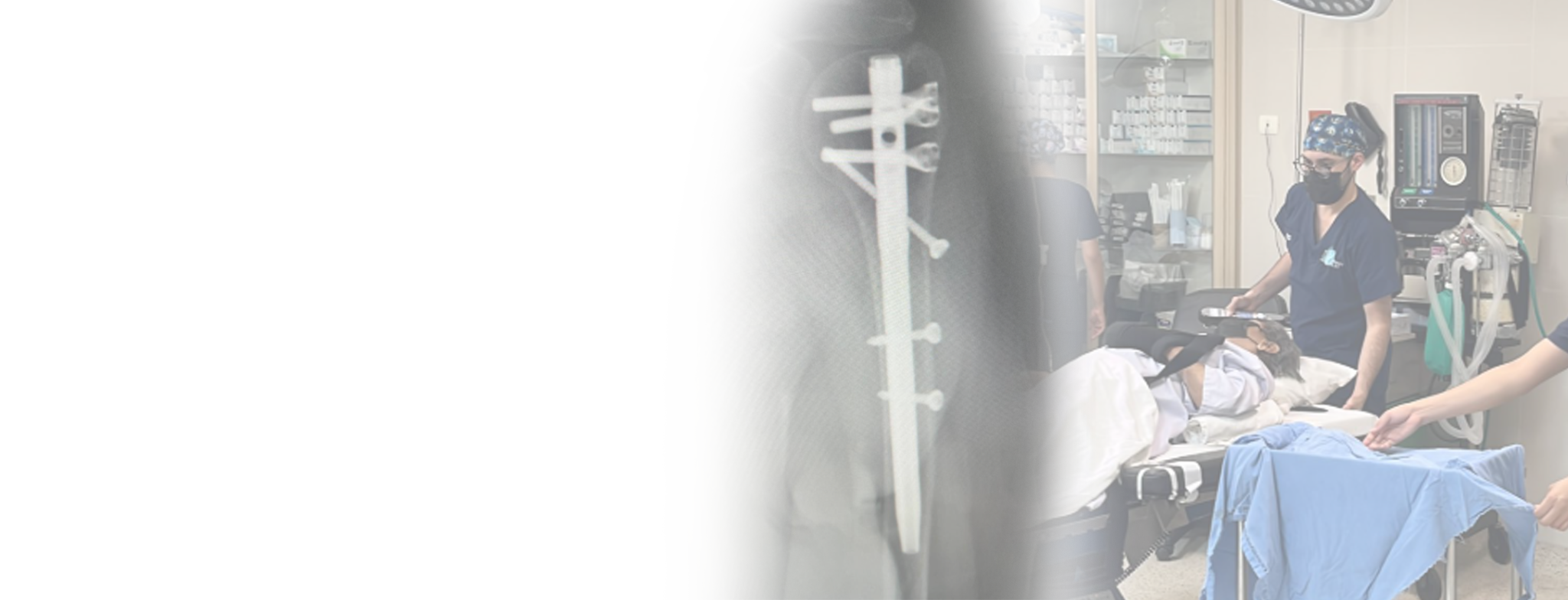 Humeral head fracture fixation with humeral intramedullary nail in the operating room