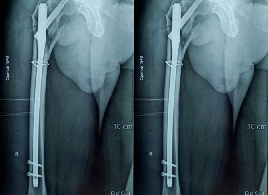 Postoperative X-ray PFNA nail anatomical alignment-CZMEDITECH