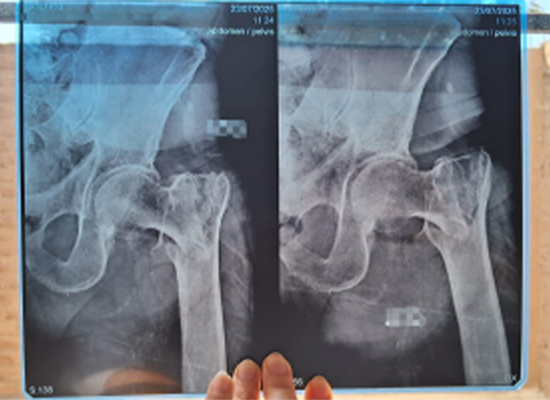 Intramedullary Nail - 82 years old