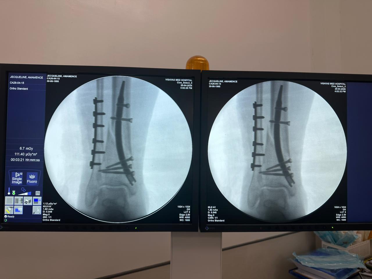 custodia-per-fissaggio-tibia-perone-distale-CZMEDITECH