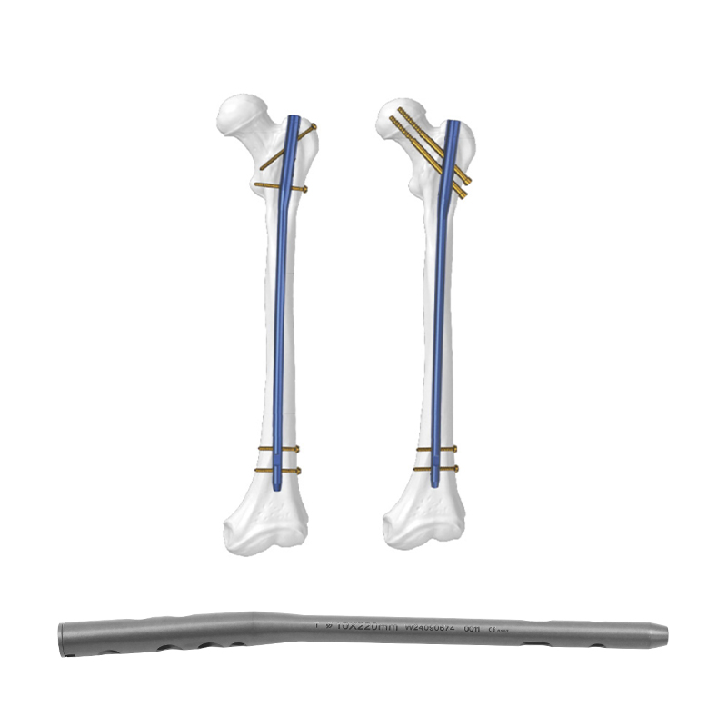 Expert-Femoral-Intramedullary-Nail