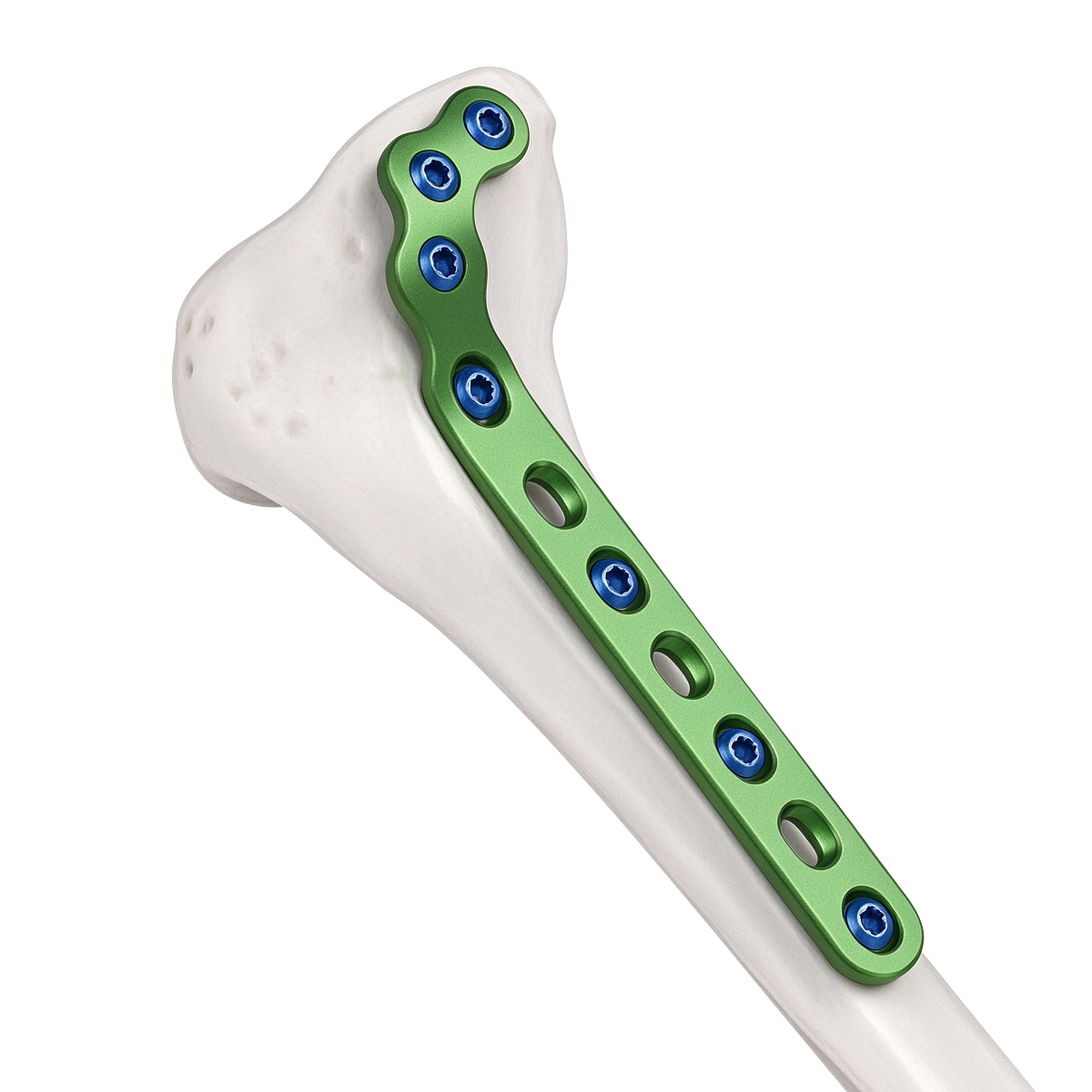 CZMEDITECH non-locking bone plate systems