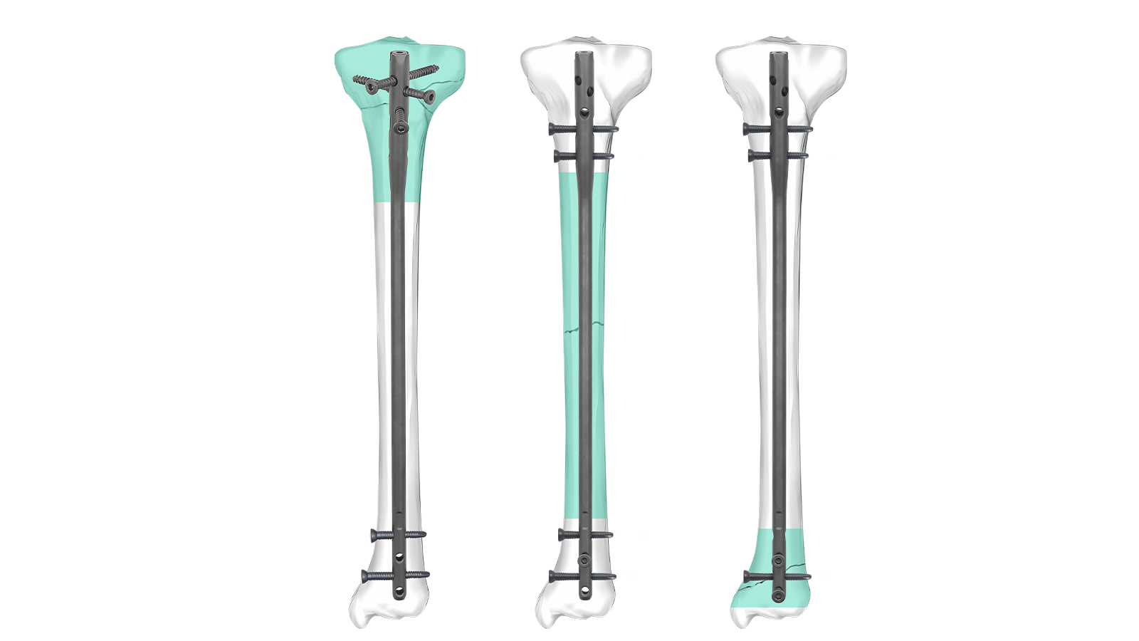 TIVO™ Expert Tibial Intramedullary Nail