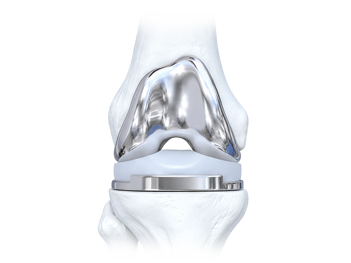 TOTAL KNEE REPLACEMENT SYSTEM-czmeditech.png