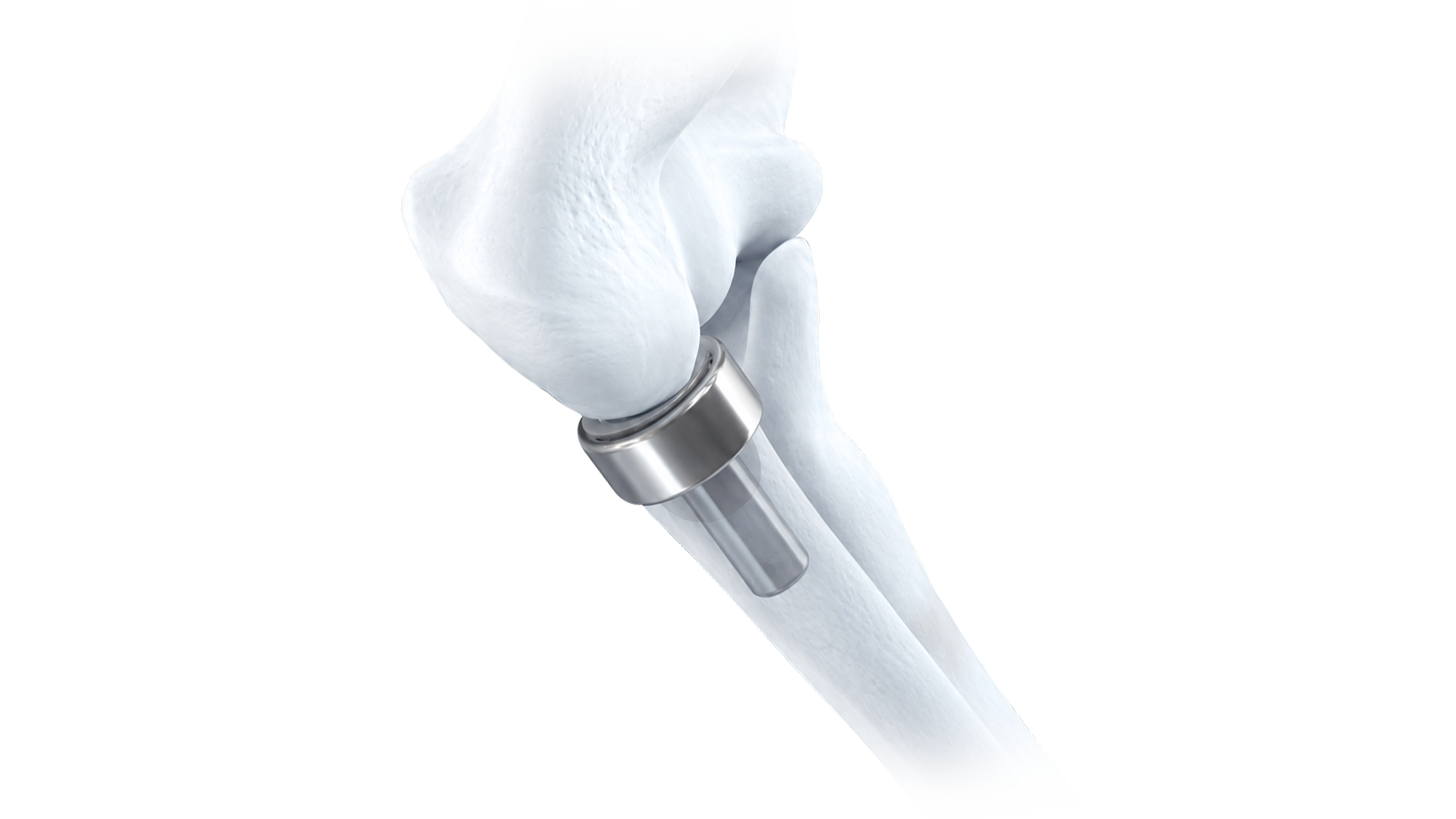 RADIAL HEAD PROSTHESIS SYSTEM.png