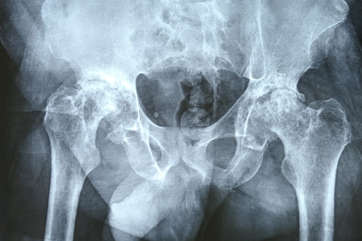 Preoperative pelvic radiograph before right total hip arthroplasty