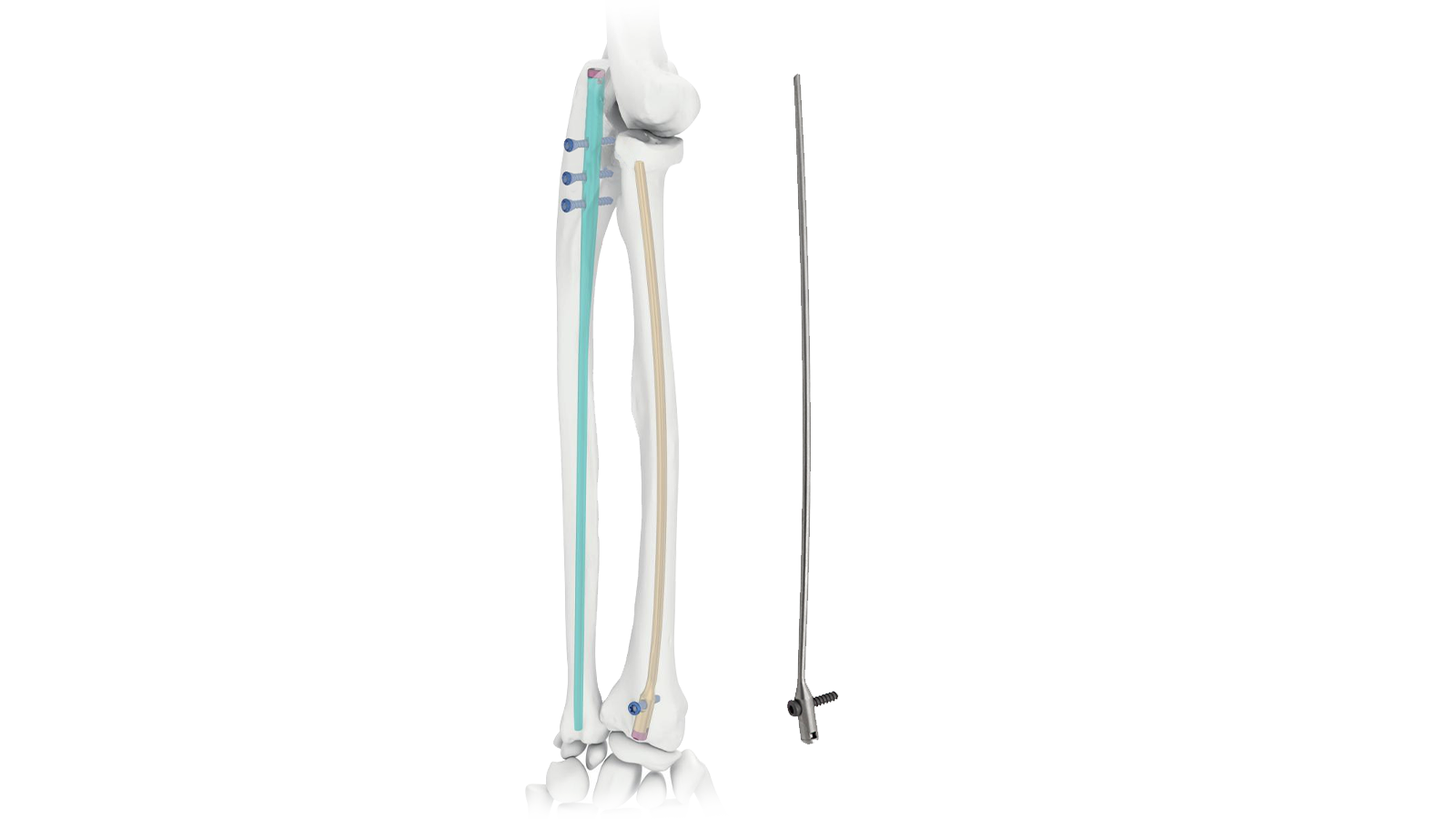 Forearm intramedullary nail system