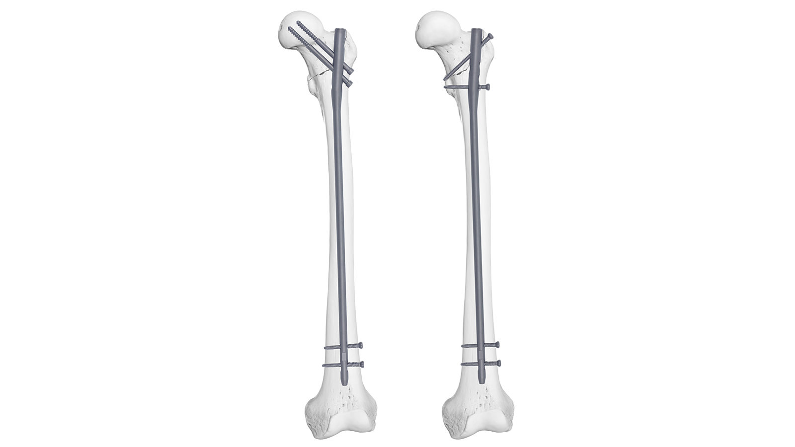 RIVO™ Expert Femoral Intramedullary Nail