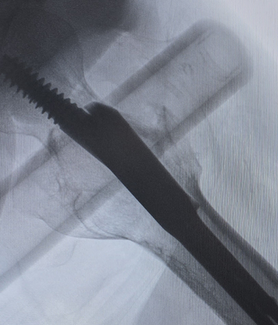 Postoperative lateral X-ray showing Intertan nail fixation