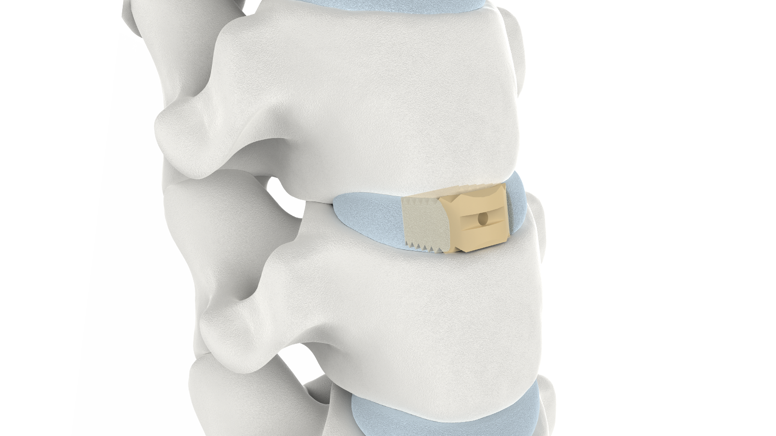 FUSA-I™ Cervical PEEK Interbody System