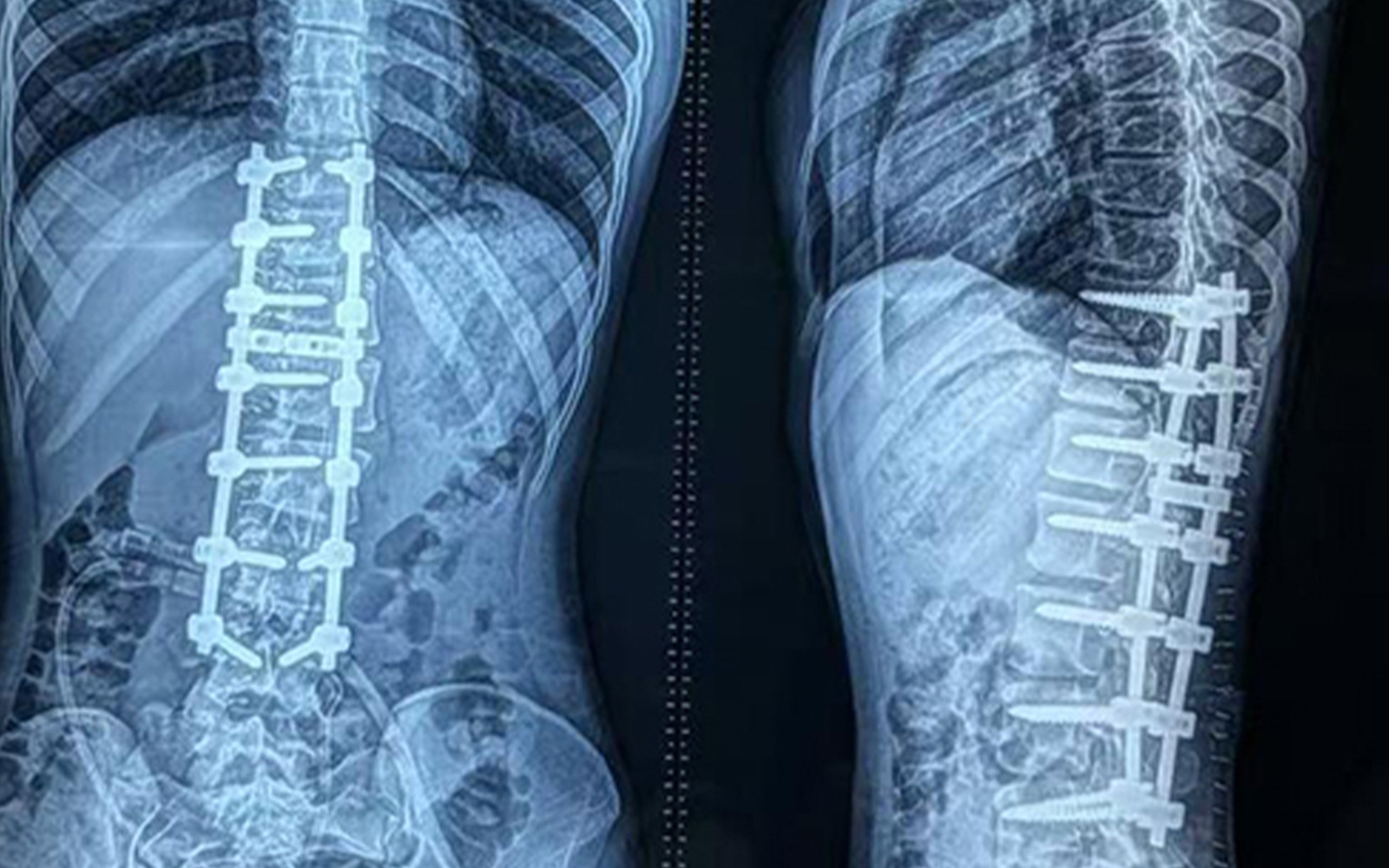 Scoliosis correction surgery in Bangladesh