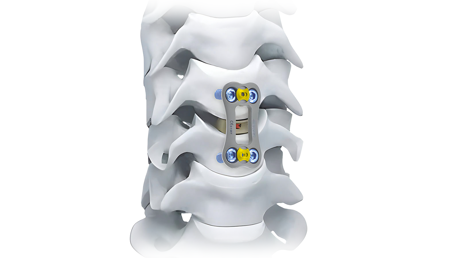 NovaFix-I™ Anterior Cervical Plate System