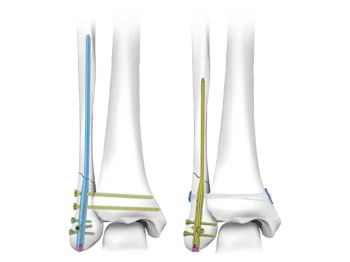 FYRO™ Expert Fibular Nail implant system