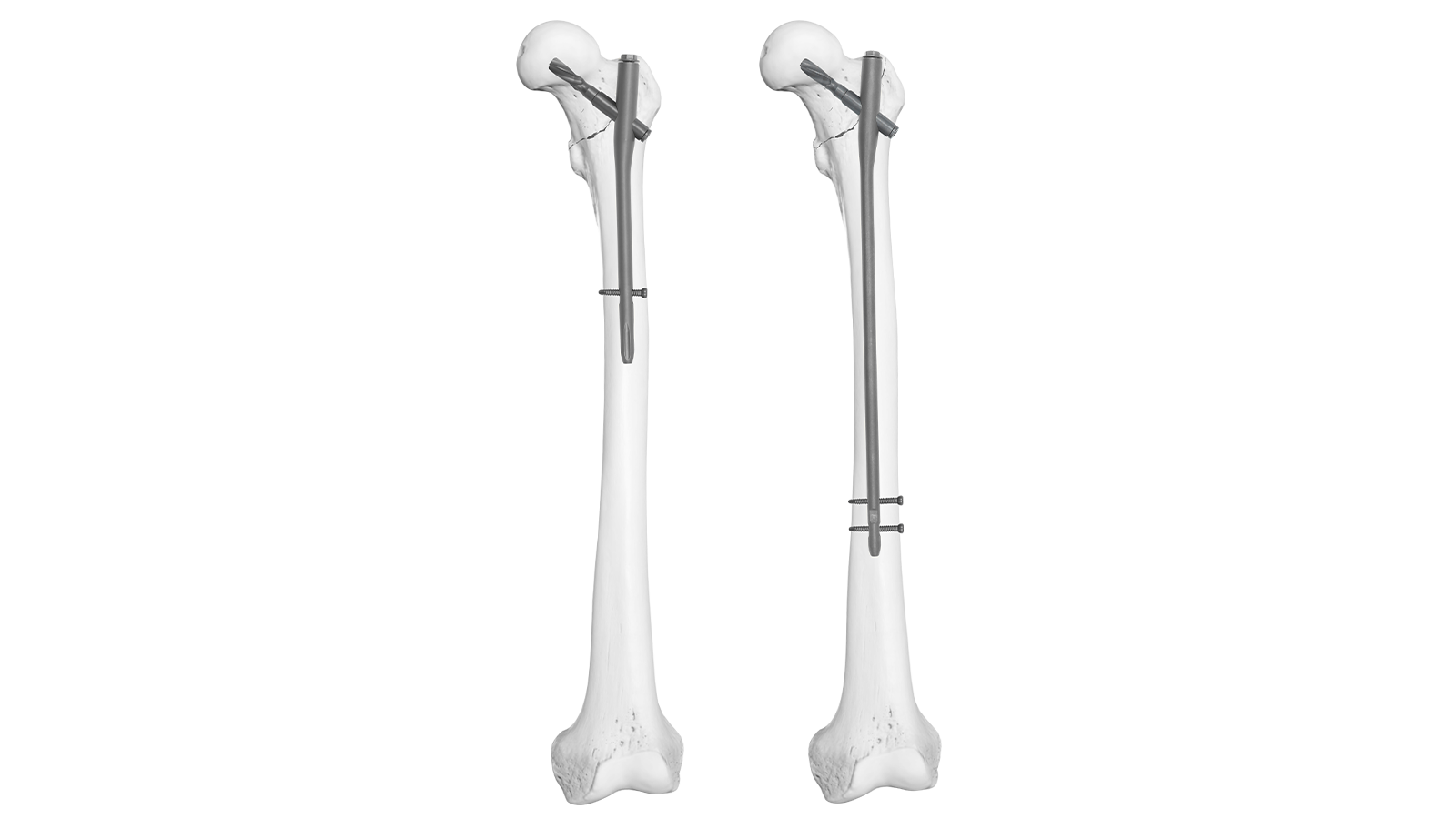 Femur intramedullary nail system