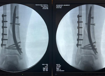 distal-tibia-fibula-fixation-CZMEDITECH.jpg
