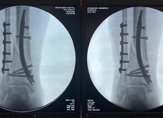 Distal Tibial Nail- 31 Years