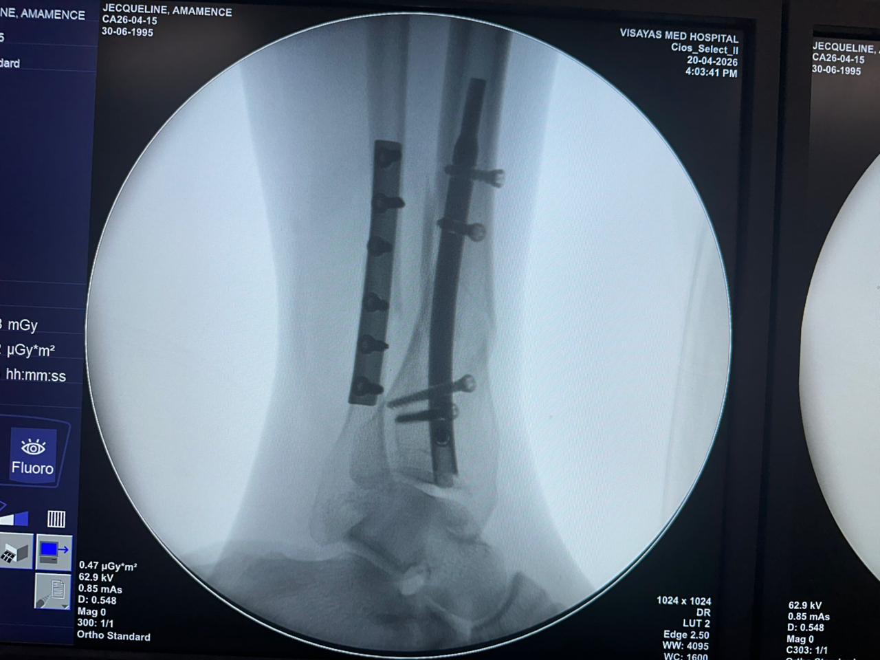 fluoroscopia-intraoperatoria-chiodo-tibia-distale-CZMEDITECH