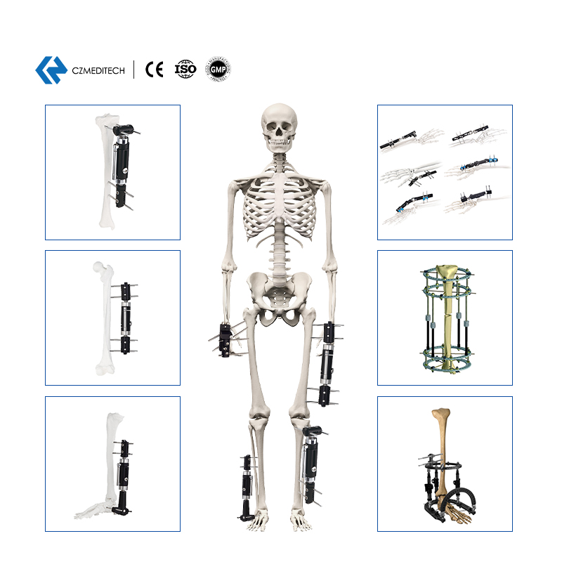 List of Orthopedic External Fixation Devices