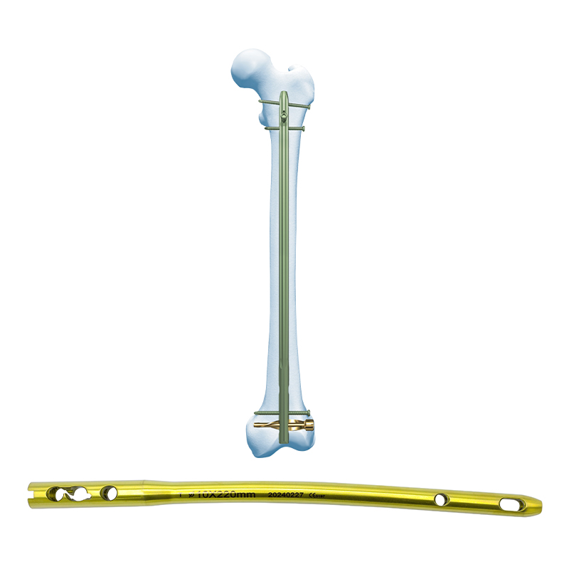 DFN-Distal-Femur-Intramedullary-Nail