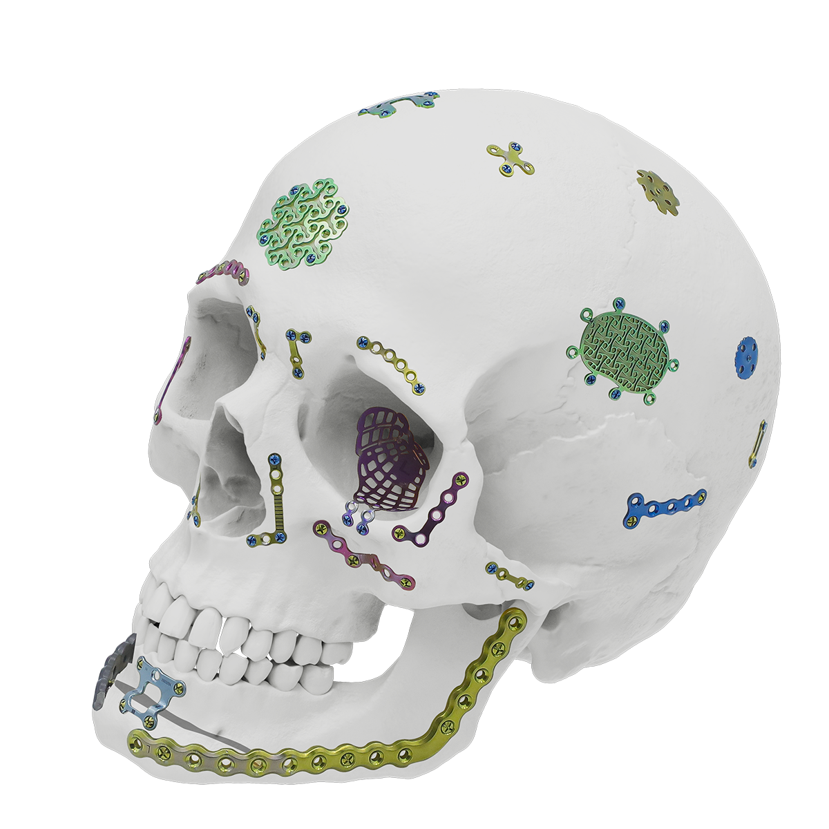 CZMEDITECH craniomaxillofacial fixation and reconstruction systems