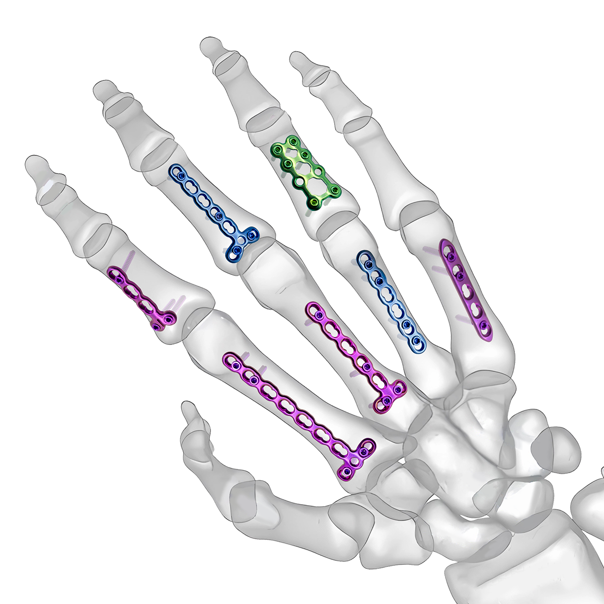 CZMEDITECH locking plates for metacarpals and phalanges