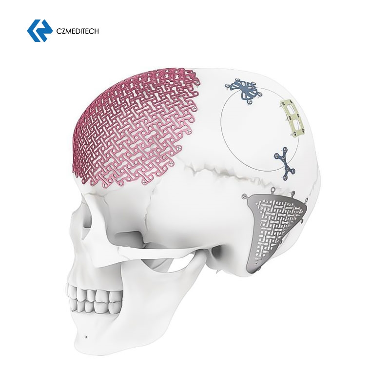 CMF and maxillofacial portfolio 6.jpg