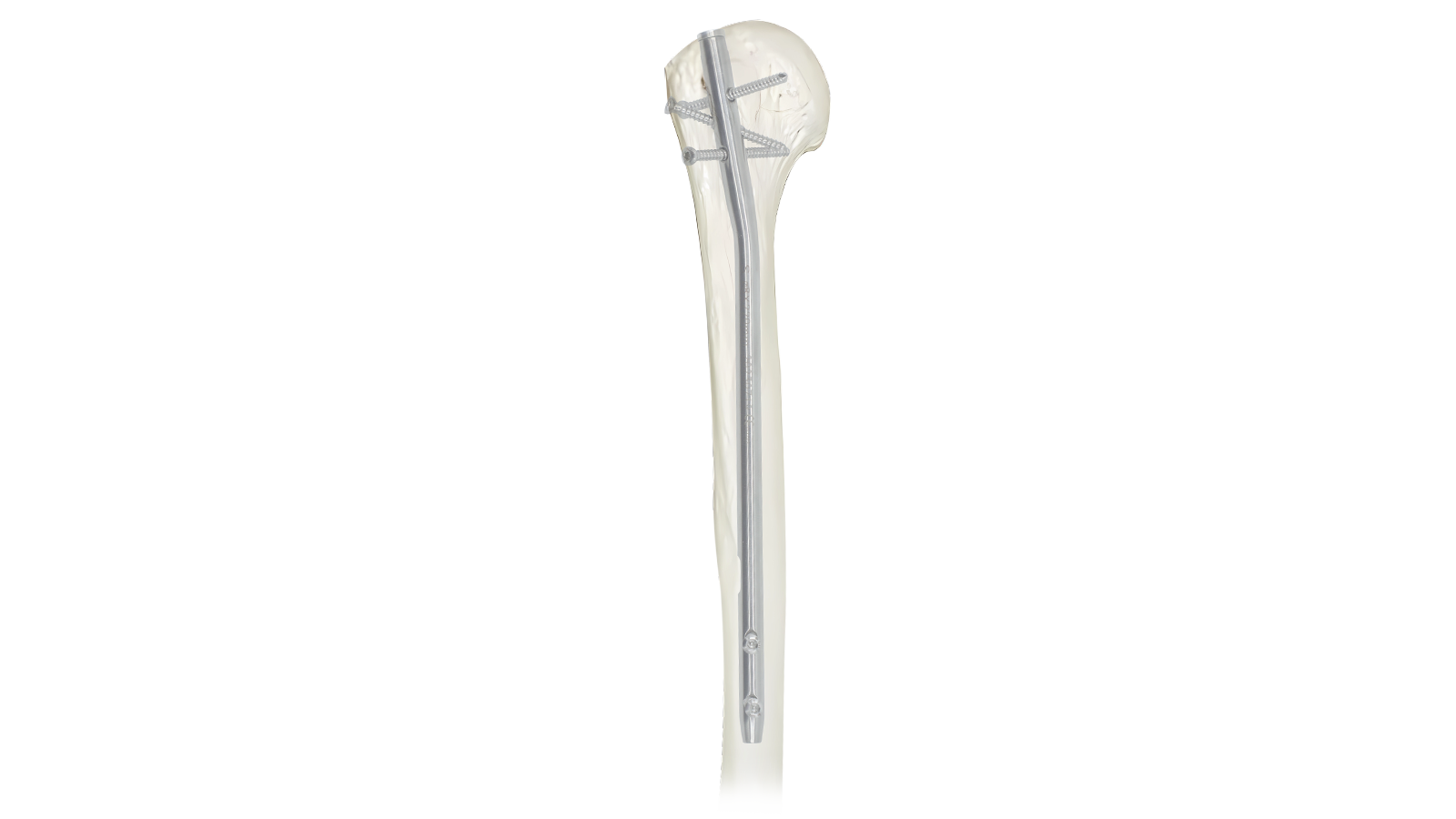 ARVO™ Humeral Intramedullary Nail