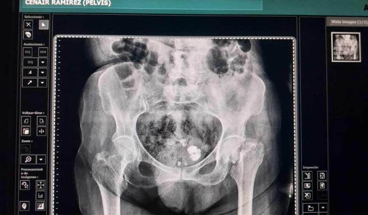 Preoperative X-ray showing a left hip fracture