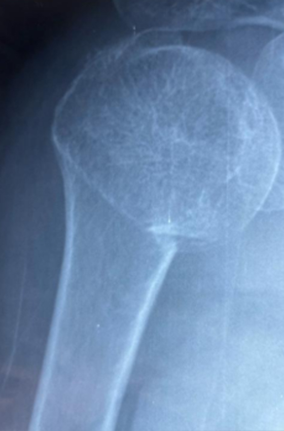 Postoperative proximal humerus radiograph