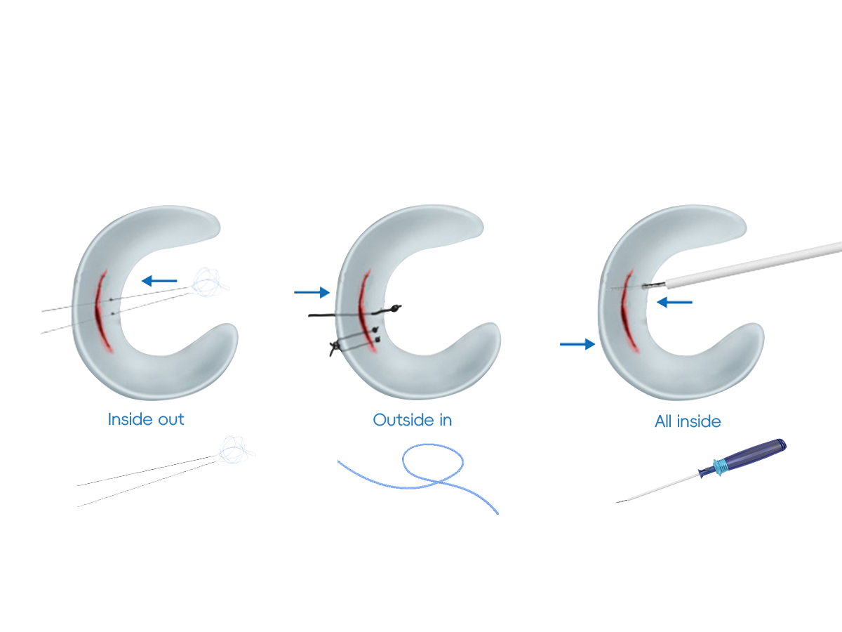 CZMEDITECH Meniscus Repair System