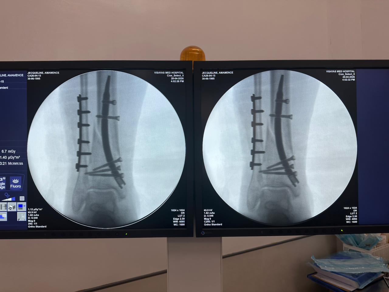 custodia-per-unghia-tibia-distale-paziente-31-anni-vista-laterale-czmeditech