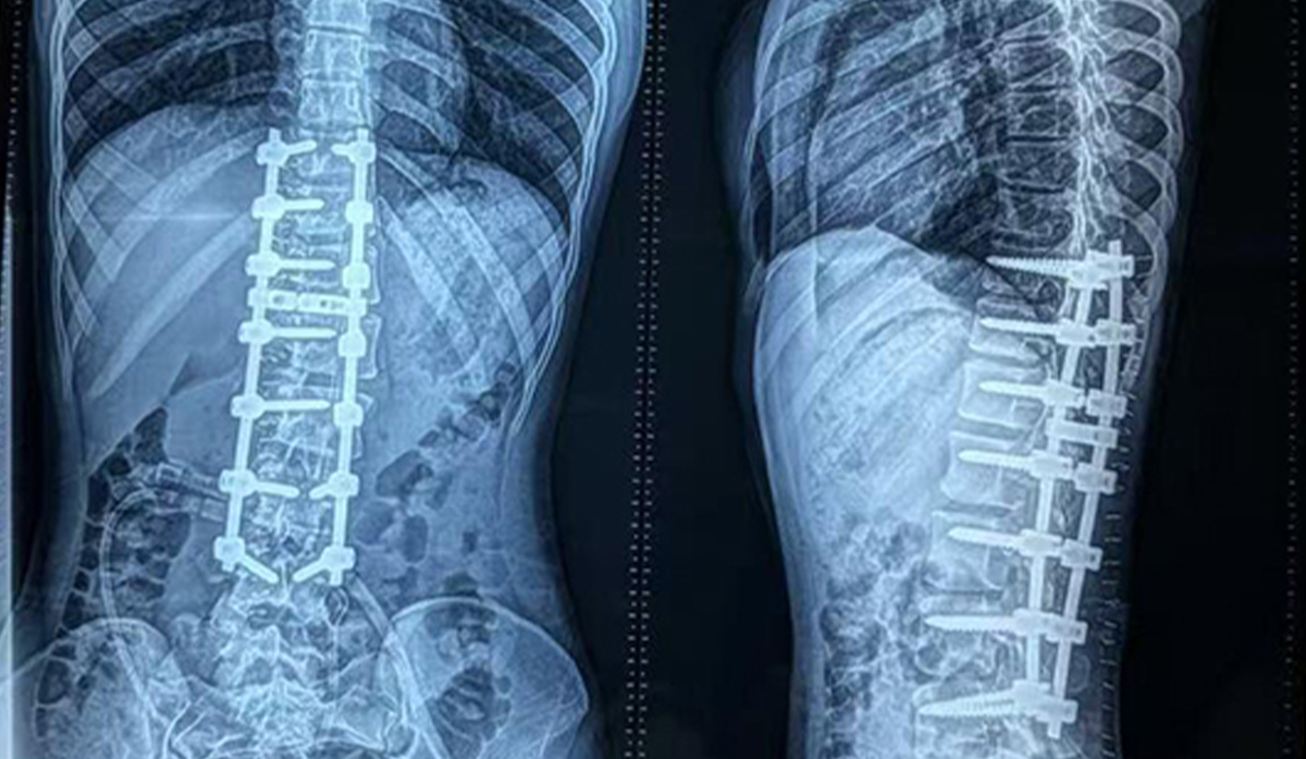 Skolioosin korjausleikkaus Bangladeshissa: 6,0 mm:n selk&auml;rangan pedicle-ruuvij&auml;rjestelm&auml;