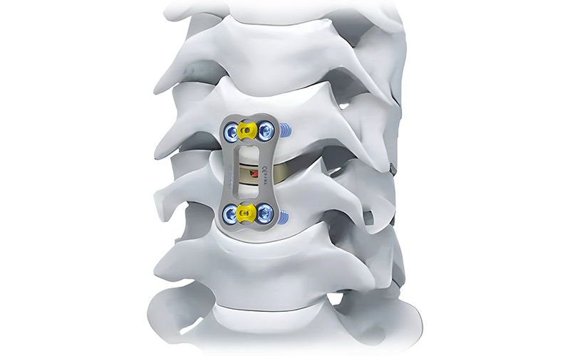 NovaFix-I-Anterior-Cervical-Plate