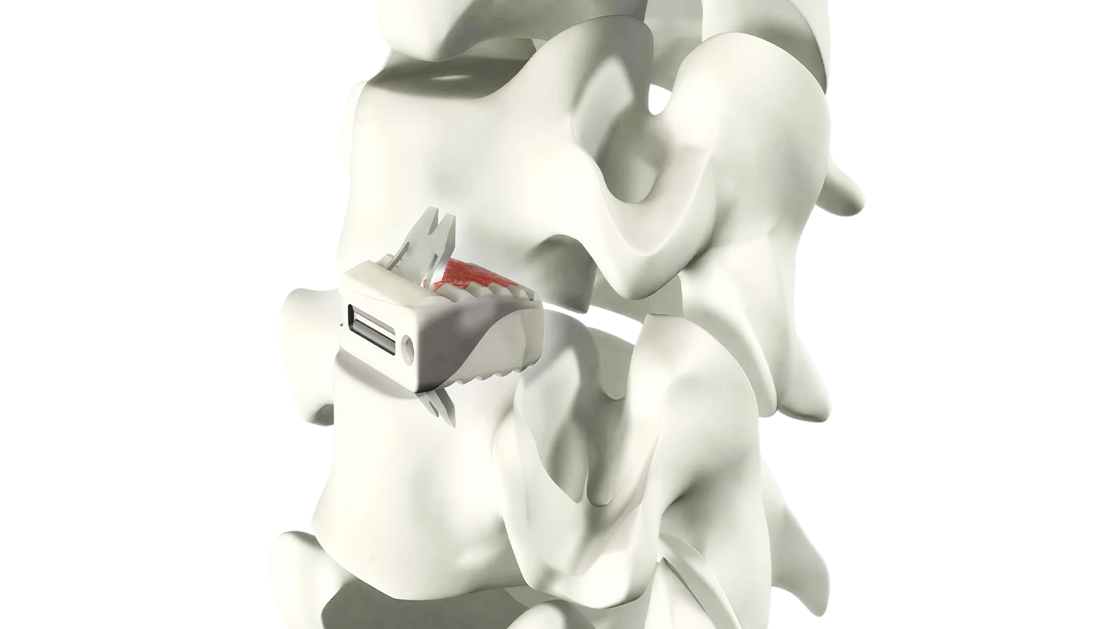 Uni-C™ Stand-Alone Cervical PEEK Interbody System