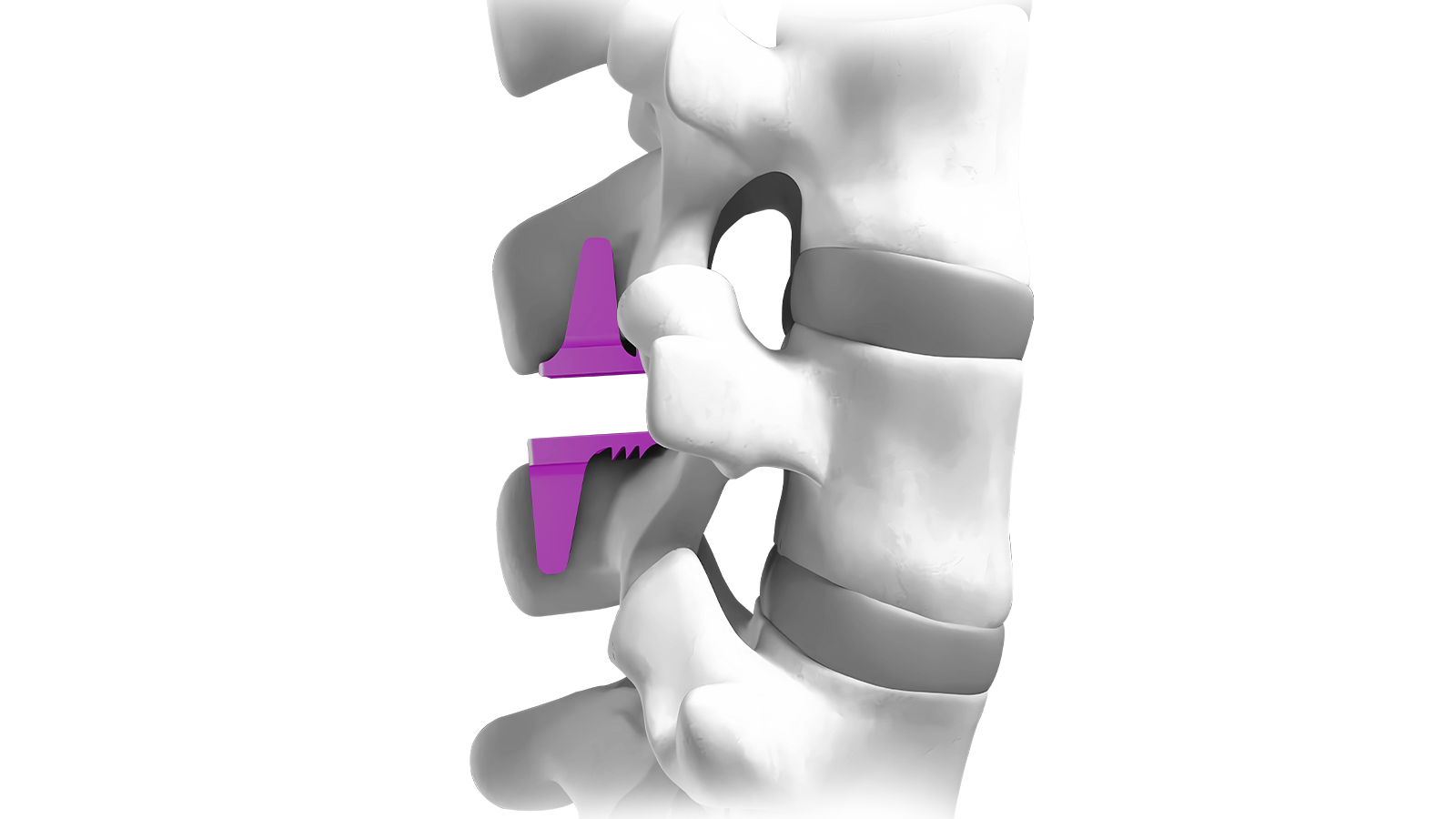 Interspinous Stabilization system