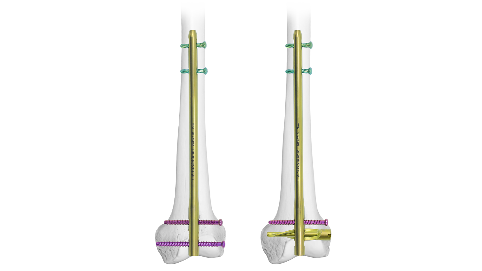 VEXA™ Distal Femoral Intramedullary Nail