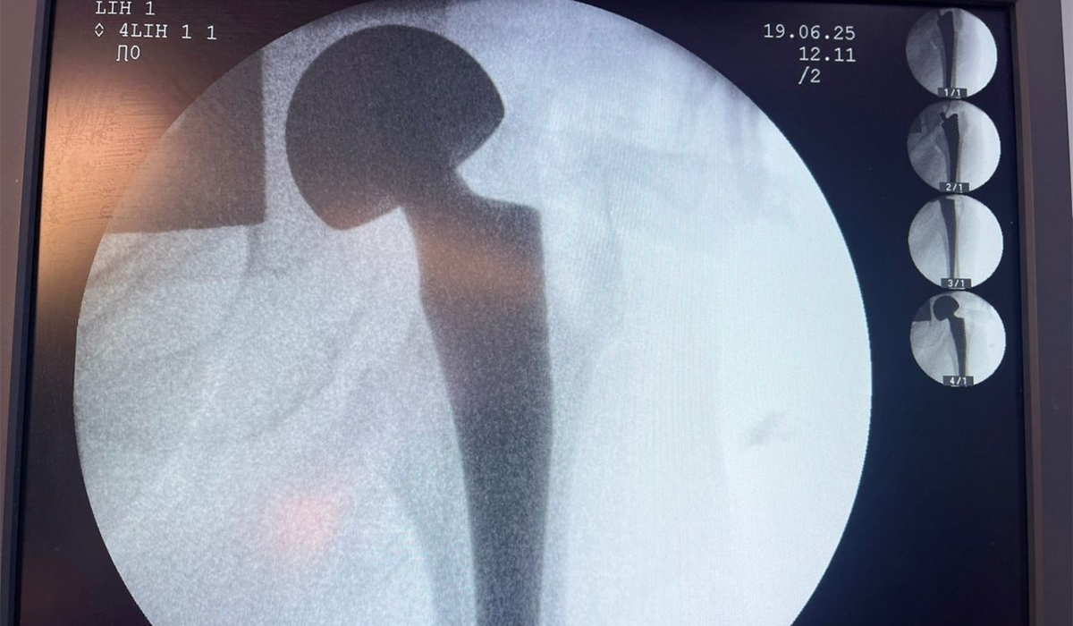 Postoperative X-ray showing a bipolar hip prosthesis with good position and stability