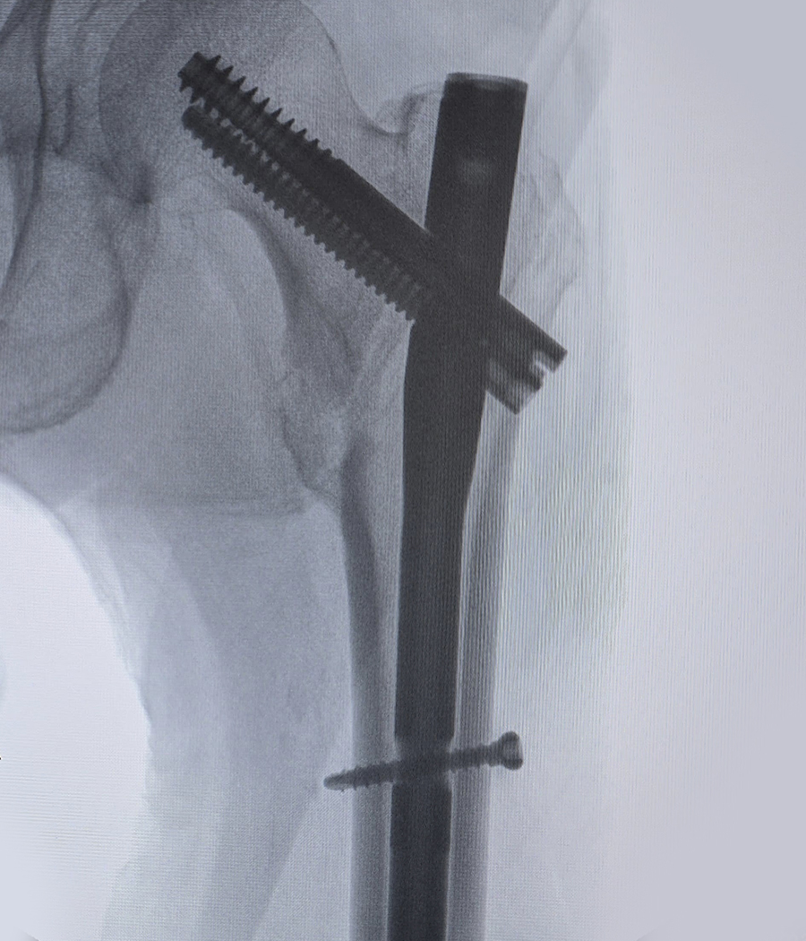 Postoperative AP X-ray showing Intertan nail fixation