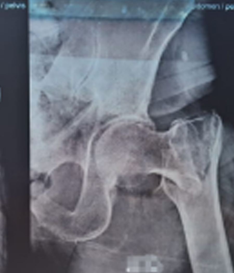 Preoperative lateral X-ray showing left intertrochanteric fracture