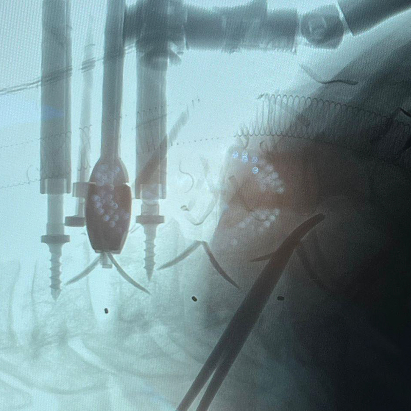 Intraoperacia cervika fuzio-fluoroskopio