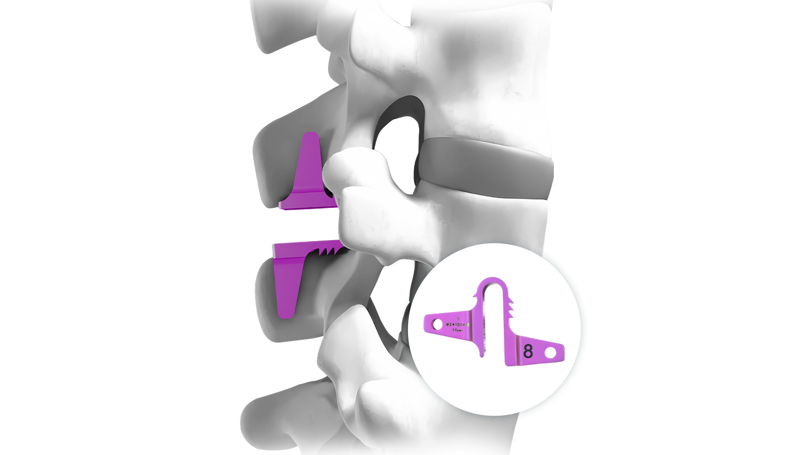 Interspinous Stabilization nhyehyɛe