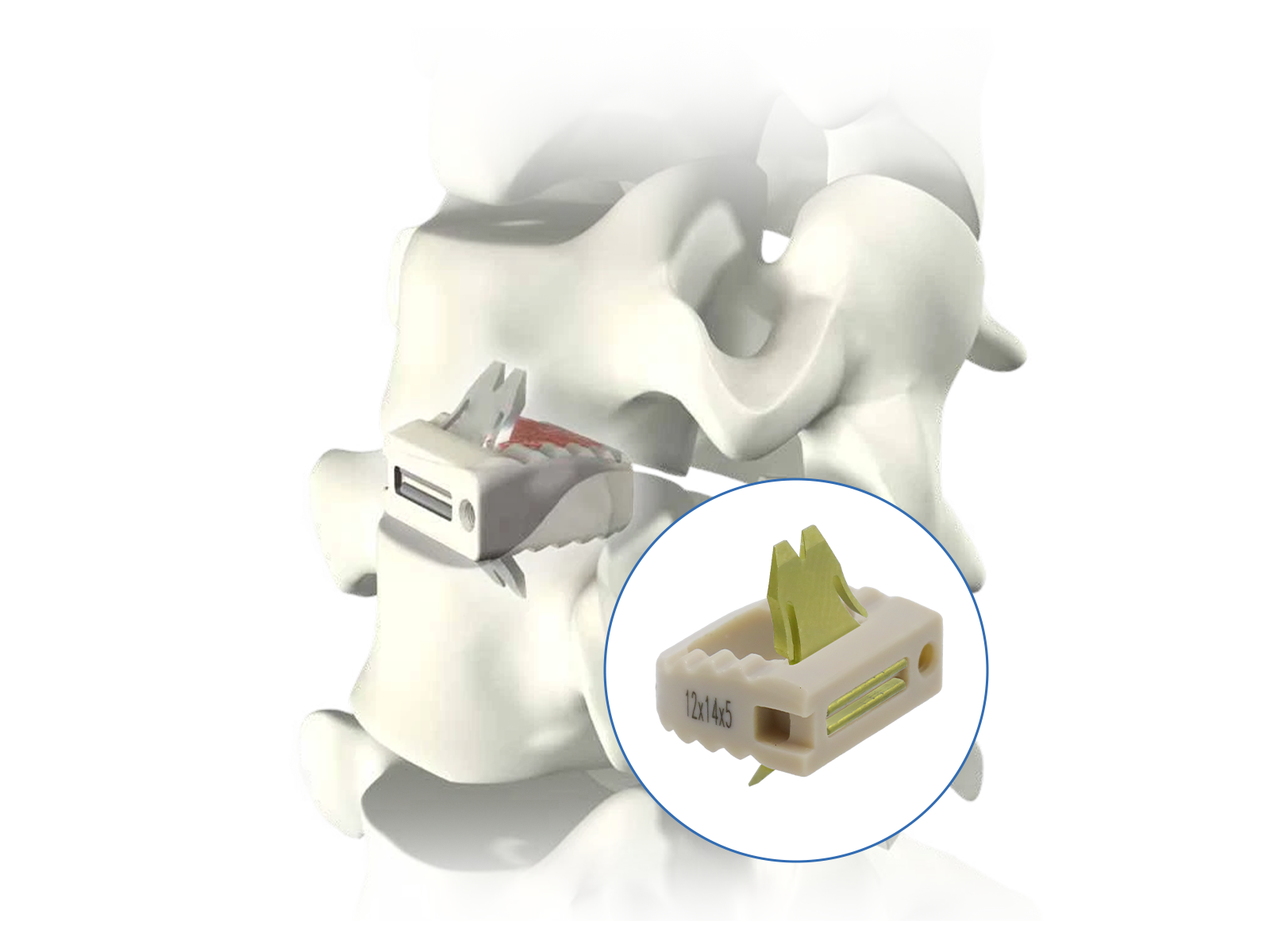 Uni-C standalone cervical interbody system