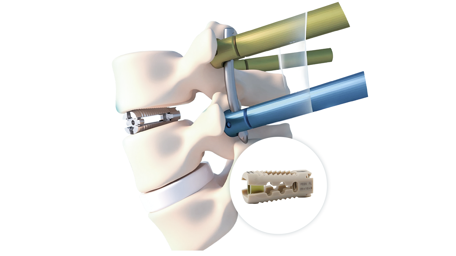 FUSA-RF™ Rafus Lumbar PEEK Interbody System