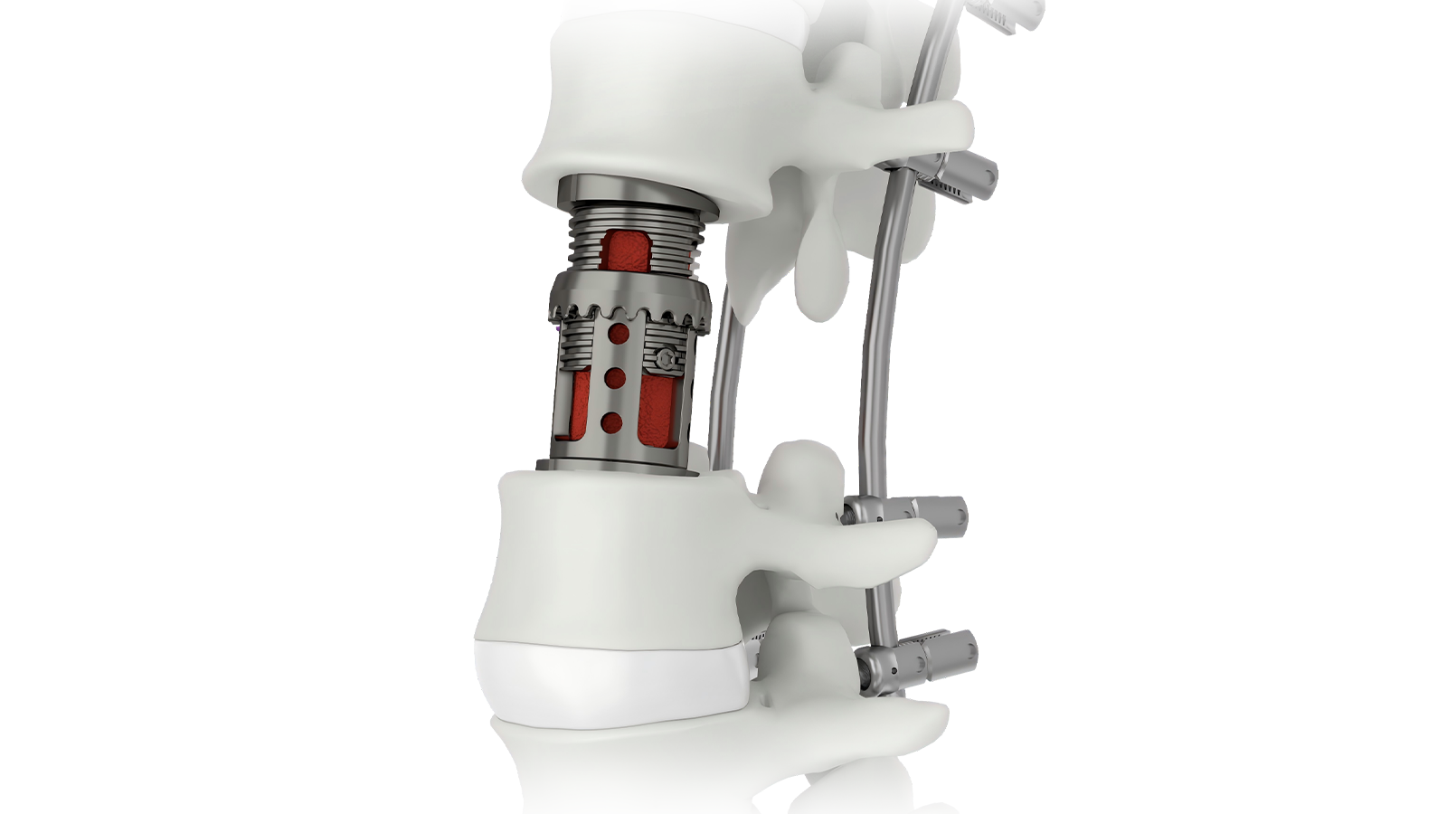 VERTA-LX™ Expandable Lumbar Reconstruction System