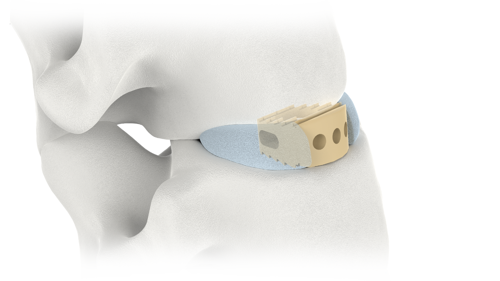 FUSA-II™ Servikale PEEK-tussenliggaamstelsel