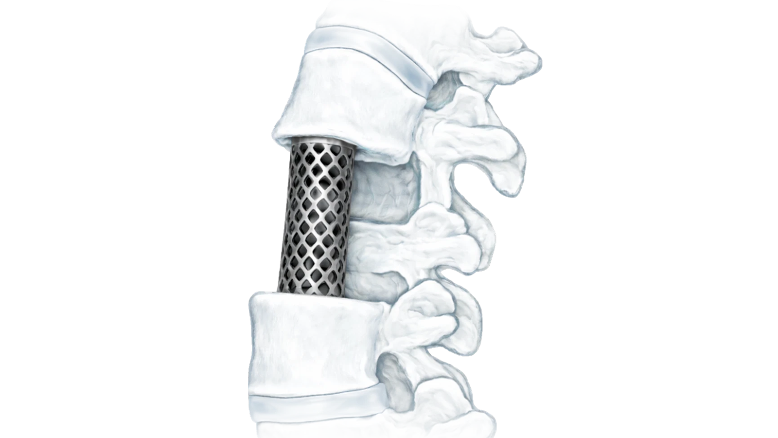 VERTA-M™ Titanium Mesh Cage System