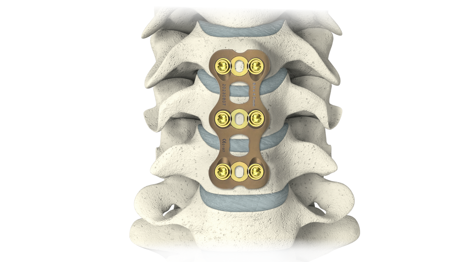 NovaFix-II™ Anterior Cervical Plate System
