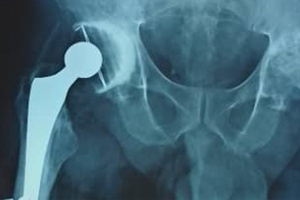 Follow-up radiograph at two months after right total hip arthroplasty